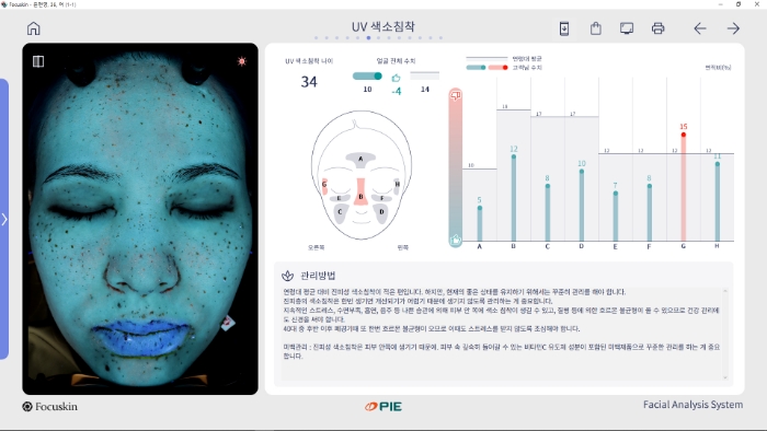 포커스킨 UV 색소 침착 화면