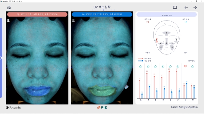FOCUSKIN UV 피부 분석 상세 화면