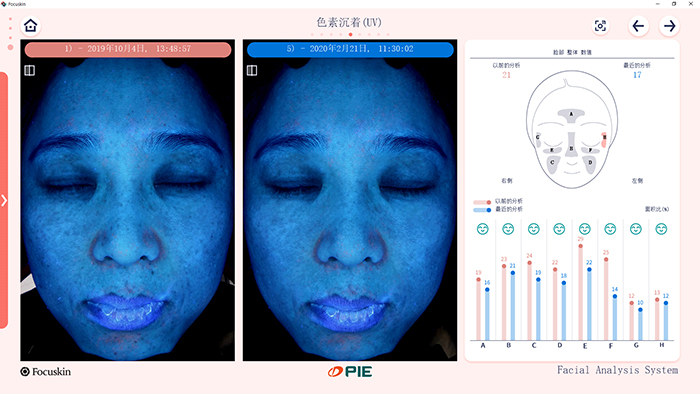 FOCUSKIN UV皮肤分析结果界面