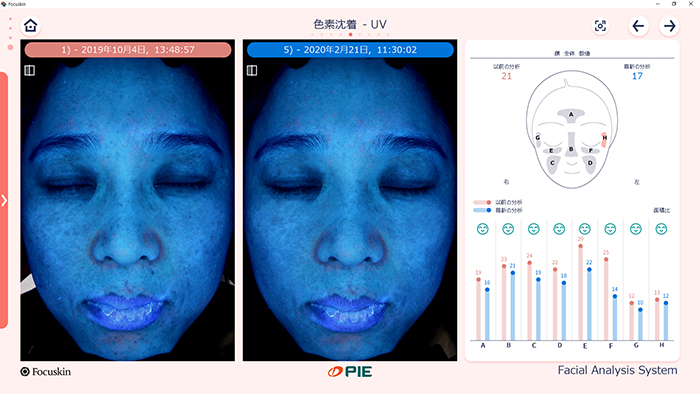 FOCUSKIN UV肌分析結果画面