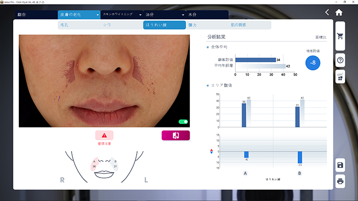 JANUS Pro ほうれい線分析画面