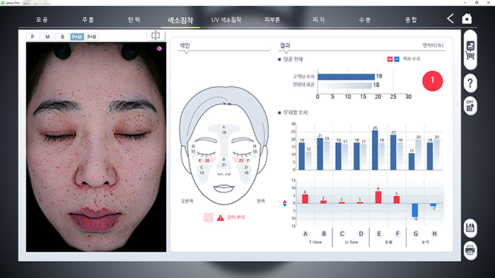 색소 침착